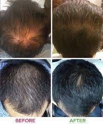 Irestore Laser Hair Growth System Essential Laser Cap Fda Cleared Hair Loss Treatments Hair Regrowth For M Hair Laser Growth Hair Growth System Clear Hair