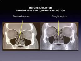 Image result for Sinus CT