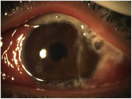 Image result for Gonococcal Conjunctivitis