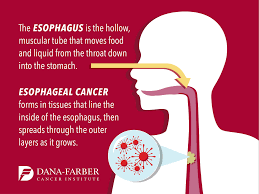 Some warning signs of breast cancer are— new lump in the breast or underarm (armpit). Signs And Symptoms Of Esophageal Cancer Dana Farber Cancer Institute