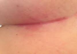 Image result for Intertrigo under breasts