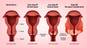 Learn more about the causes, symptoms, diagnosis, treatment, prevention, and outlook. Cervical Cancer Stages Prof Andreas Obermair Professor Andreas Obermair