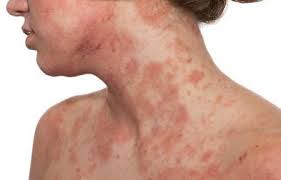 Resultado de imagen para dermatitis