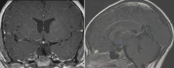 Pituitary Stalk Interruption Syndrome 4 Years Old Girl Presented For Download Scientific Diagram