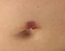 I Ripped Out My Belly Button Piercing On Accident It Was Four Months Old What Do I Do Piercing