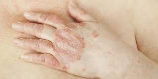 Itulah paparan tentang beberapa jenis obat alami untuk menyembuhkan gatal pada kulit anak. Ubat Penyakit Kulit Badang Ubat Tradisional Yang Berasaskan Akar Akar Kayu Sesuai Untuk Penyakit Badang Kulit Psoriasis Bertompok Sendi Sendi Berdebu Di Kulit Kepala Tapak Tangan Dan Ubat Ubatan Tradisional Melayu Badang Resdung Medu Uluran