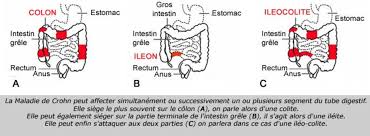 Le côlon appartient à l'appareil digestif. Figure 1 From Role De Conseil Du Pharmacien D Officine Dans La Prise En Charge D Un Patient Atteint De La Maladie De Crohn Semantic Scholar