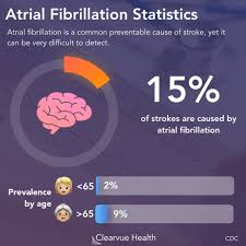 It occurs when there are too many electrical signals that normally control the heartbeat, causing the upper chambers of the heart (the atria) to beat extremely rapidly (more than 400 beats per minute) and quiver (fibrillate). 4 Charts Ai Diagnoses Atrial Fibrillation In Normal Sinus Rhythm Visualized Science
