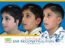 Meet our amazing patient, Defne! Born with unilateral, Grade III microtia,  she now celebrates life with her new ear and sparkling earrings that light  up her smile. We know dear Defne has