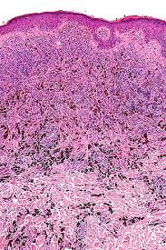 Image result for Blue Nevus