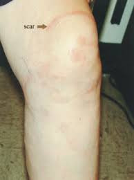 Check spelling or type a new query. Leg Rash Photo Quiz American Family Physician