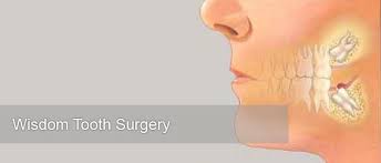 Contrary to popular belief, even if your wisdom teeth are not causing any problems, you might still where to get a wisdom tooth extraction. Malaysia Smile Wisdom Tooth Surgery