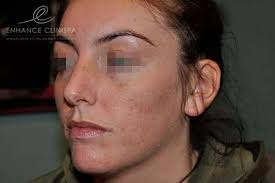 Microneedling in Bolton, Manchester