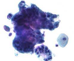 Some countries, such as denmark, finland, sweden and germany, have lower tuition fees and are also increasing the number of degrees taught in english. Adenocarcinoma Wikipedia