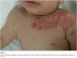 Image result for shingles in children