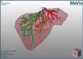 Liver and gallbladder anatomy location and functions. Planning Data As Obtained From Mevis Depicting The 3d Liver Model As Download Scientific Diagram