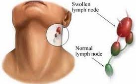 This video is about faucial diphtheria from diseases of pharynx section of ent. Are You Suffering From Bacterial Throat Infection My Urgent Care Virginia