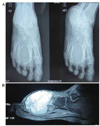 Aneurysmal bone cystti pathology reviewpt. Aneurysmal Bone Cyst Of The Metatarsal A Case Report