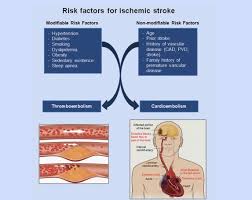 Image result for Stroke Pathophysiology