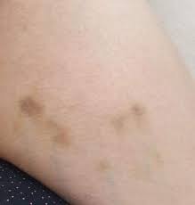 Blaue Flecken Angst Vor Leukamie