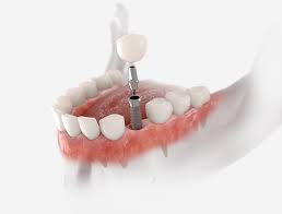 Image result for dental implant