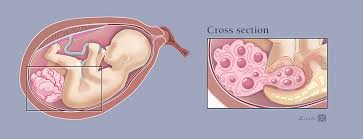 It is found to arise in one out of every 35,000 newborns. Sacrococcygeal Teratoma Fetal Health Foundation
