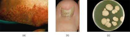 Gray patch, black dot, and favus. Mycoses Of The Skin Microbiology