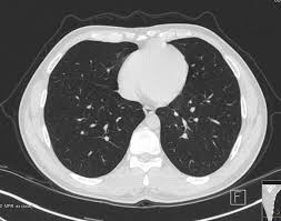 Ct Thorax Ursachen Vorbereitung Auswertung Praktischarzt