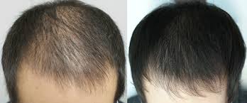 For example, balding is one of the major genetic traits leading to hair loss. Hair Growth Secrets Ways Tips Www Savol Javob Com