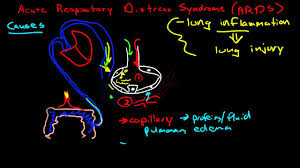 Acute Respiratory Distress Syndrome