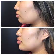 Unparalleled customer support to ensure you're supported every step of the way. Chin Filler In Reno Nv Face Forward Aesthetics