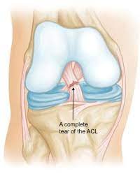 It prevents the tibia from sliding out in front of the femur, as well as provides rotational stability to the knee. Anterior Cruciate Ligament Acl Injuries Orthoinfo Aaos