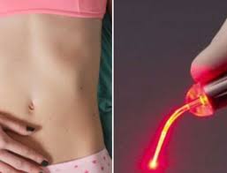 Monalisa Touch Laser Cost Vaginal Atrophy Treatment Plano Frisco Dallas Tx
