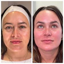 This organization primarily operates in the spas business / industry . Smoothglo Find A Laser Resurfacing Treatment Near Me Lumenis