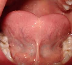 Their tongue looks shorter or doesn't stick out as much. Tongue Tie Ankyloglossia Diagnosis Symptoms Surgery And More