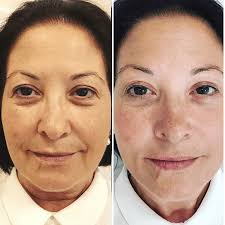 Hyaluronsaure Filler Ordination Dr Benjamin Gehl