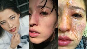 What is the best treatment for a chemical burn? Woman S Face Severely Burned In Essential Oil Diffuser Accident Allure