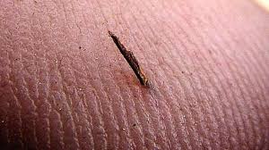 Une P Tite Echarde Bien Enfoncee Sous La Peau C Est Difficile A Enlever C Est Vrai Pour Les Pieds Les Doigts Ou Pire Si C Est Enlever Echarde Echarde Astuces