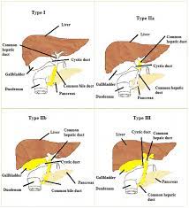 Biliary atresia, also known as extrahepatic ductopenia and progressive obliterative cholangiopathy, is a childhood disease of the liver in which one or more bile ducts are abnormally narrow, blocked, or absent. Biliary Atresia Recent Insight Sciencedirect