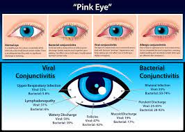 Conjunctivitis Or Pink Eye Is An Inflammation Of The Conjunctiva The Clear Mucous Membrane That Covers The White Part Of The Eye And The Inside Of The Eyel