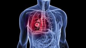 How to detect lung cancer: How Ai Can Detect Lung Cancer From Ct Scans Full Stack Feed