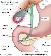 Litiaza biliara este o afectiune frecvent intalnita, caracterizata prin formarea de calculi (,,pietre') in vezica biliara. Litiaza Biliara Simptome Gastroenterologie Hepatologie Endoscopie