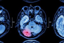 A double concussion is a concussion that immediately follows the first concussion, or occurs before the injured party is asymptomatic. Concussion Side Effects May Cause Gastrointestinal Problems Study Aboutlawsuits Com