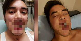 The battery in the device allegedly may have been the cause. Mom Warns Against Vape Pen After One Explodes Leaving Son With Broken Jaw 808novape