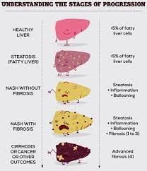 The European Fight Against Nash The Silent Liver Disease