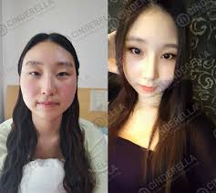 Korea Revision Rhinoplasty Cinderella Plastic Surgery