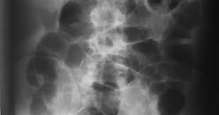 Rigler Sign Radiology Case Radiopaedia Org Radiology Imaging Radiology Radiography