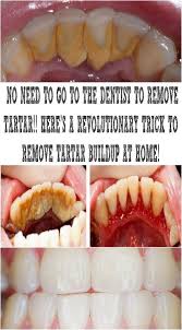 No Need To Go To The Dentist To Remove Tartar Here S A Revolutionary Trick To Remove Tartar Buildup At Home Teeth Health Dentist Natural Home Remedies