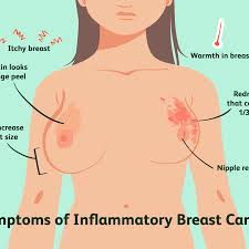 Ibc is easily confused with a breast infection, especially in a mammogram doesn't usually detect ibc, but it can help with diagnosis. Inflammatory Breast Cancer Overview And More