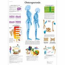 osteoporosis